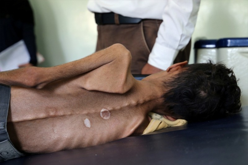 Yemeni boy,10, suffering from severe malnutrition lies on a bed at a hospital in Jabal Habashi on the outskirts of the city of Taiz, on October 30, 2018. (AFP Photo)