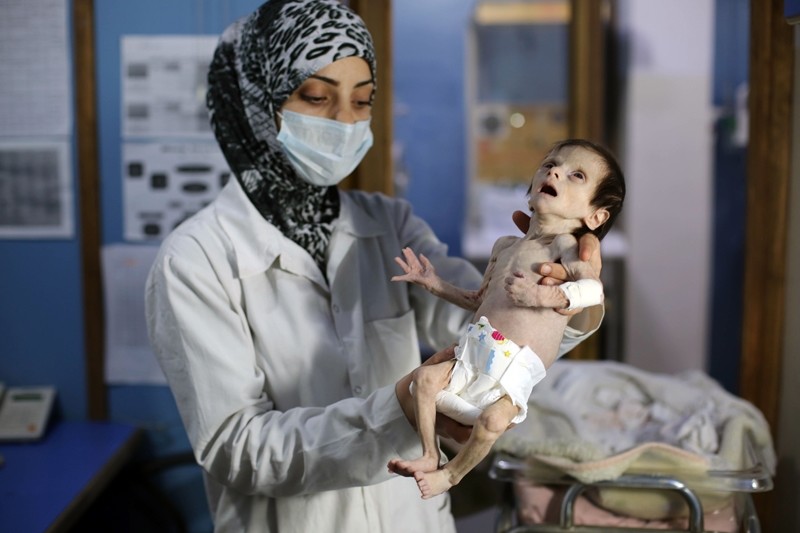 A Syrian infant suffering from severe malnutrition is carried by a nurse at a clinic in the town of Kafr Batna, in the eastern Ghouta region on the outskirts of the capital Damascus (AFP Photo) 