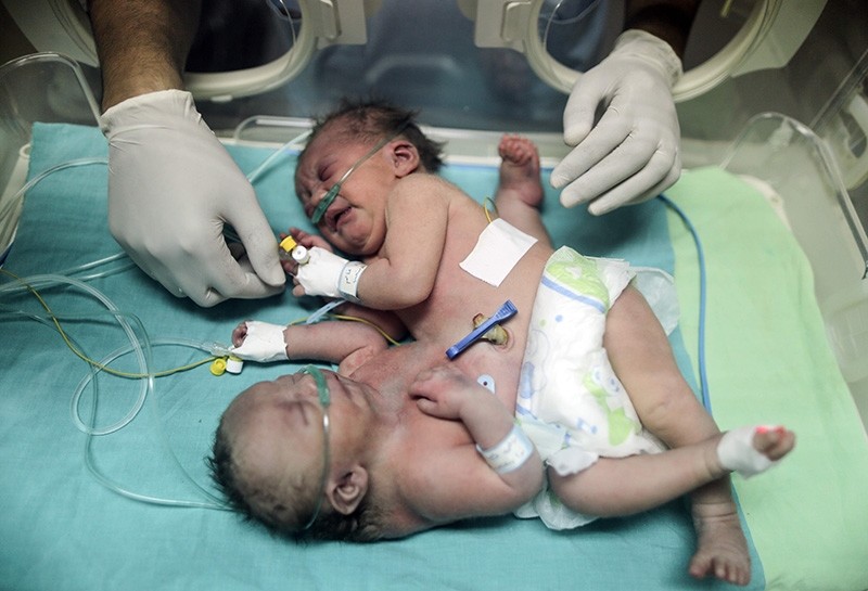 This file photo taken on October 22, 2017 shows then one-day-old Palestinian conjoined twins in an incubator at the nursery at the al-Shifa Hospital in Gaza City. (AFP Photo)