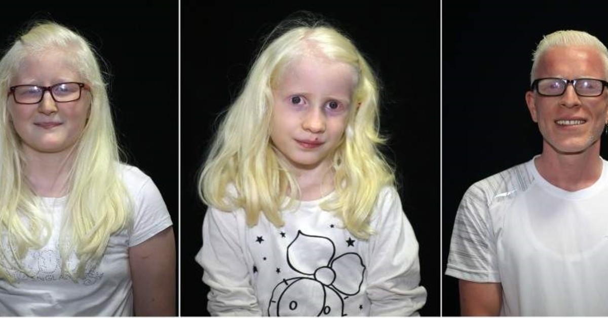 In search of shadows: Being albino in the sunniest city | Daily Sabah In search of shadows: Being albino in the sunniest city | Daily Sabah