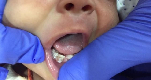 أطباء يقتلعون 7 أسنان من فم رضيع بعمر شهر في الهند
