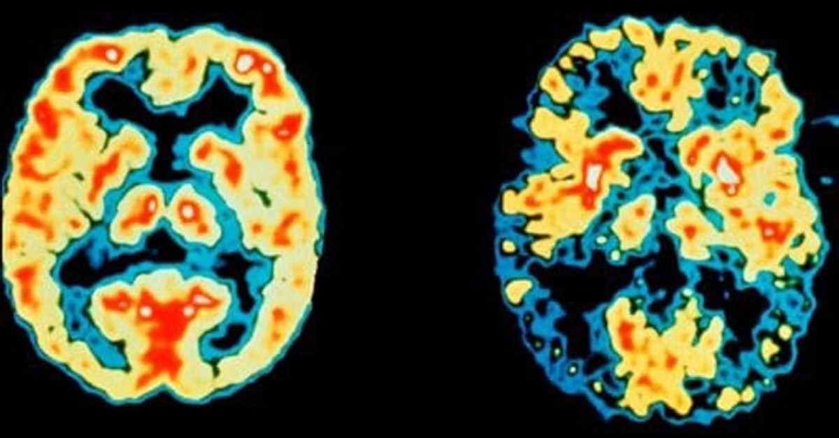 PET scans of the brain of a normal patient (left) versus an Alzheimer's disease patient. The scan on the right shows reduction of both function and blood flow in both sides of the brain, a feature often seen in Alzheimer's. (FILE Photo)