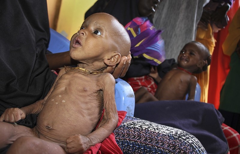 In this photo taken Saturday, Feb. 25, 2017, malnourished baby Ali Hassan, 9-months-old, left, is held by his mother Fadumo Abdi Ibrahim at a feeding center in a camp in Mogadishu, Somalia. (AP Photo)