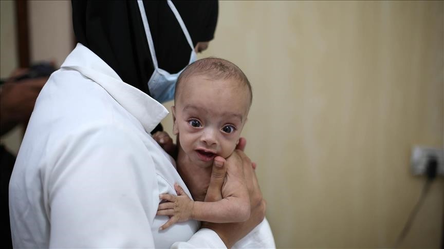 A Syrian baby is seen in doctor's arms as him and other babies go through medical examinations due to malnutrition in de-conflict zone of Eastern Ghouta of Damascus, Syria on October 14, 2017. (Anadolu Agency) 