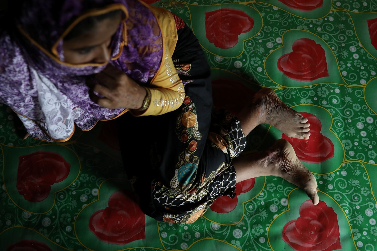 Begum, a Rohingya rape victim, shows her scars as she poses for a picture in Teknaf, Bangladesh, June 25, 2018. Picture taken June 25, 2018.