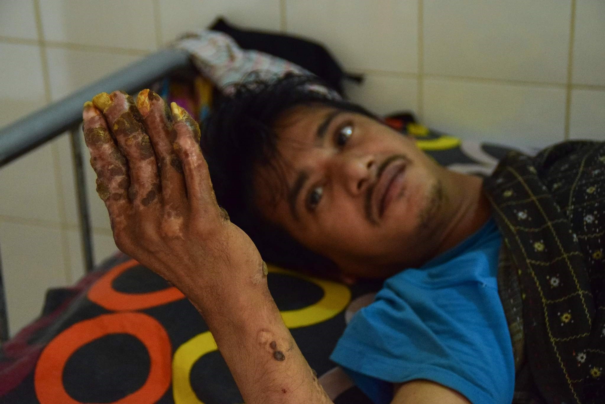 This picture taken on January 31, 2018 shows ,Tree Man, Abul Bajandar at Dhaka Medical College Hospital in Dhaka. (AFP Photo)