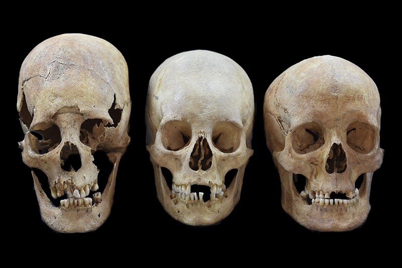 Undated photo provided by the State collection for Anthropology and Palaeoanatomy Munich shows strong, intermediate and non-deformed skulls, from left, from the Early Medieval sites Altenerding and Straubing in Bavaria, Germany. (AP Photo)