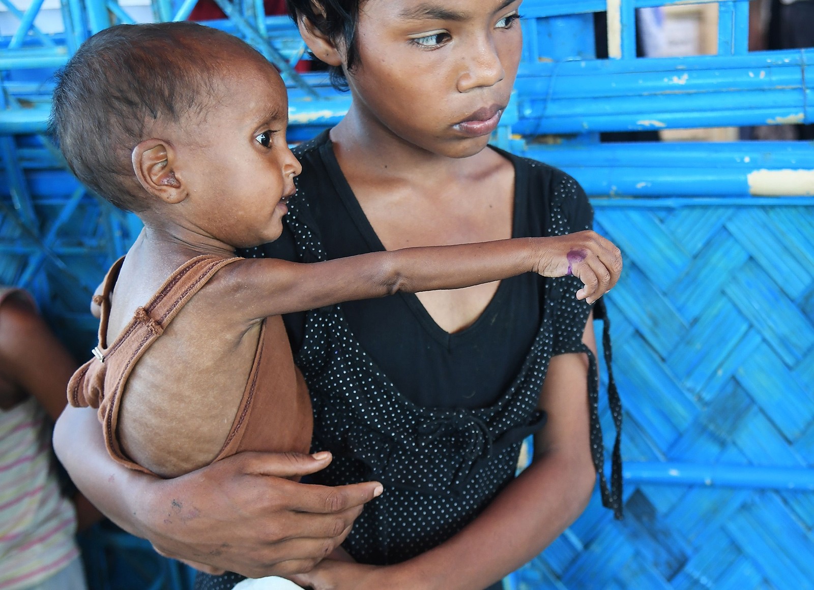 Zahid Hasan, the 1.5 years old Rohingya Muslim refugee with her sister waits to see a doctor to receive treatment for severe malnutrition at the Balukhali refugee camp in Bangladesh's Ukhia district on November 6, 2017. (AFP Photo)