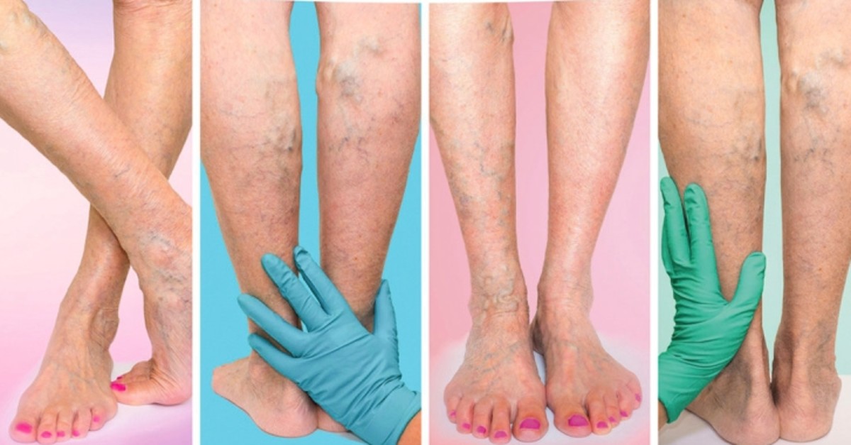 5 reasons you get varicose veins and tips to avoid them