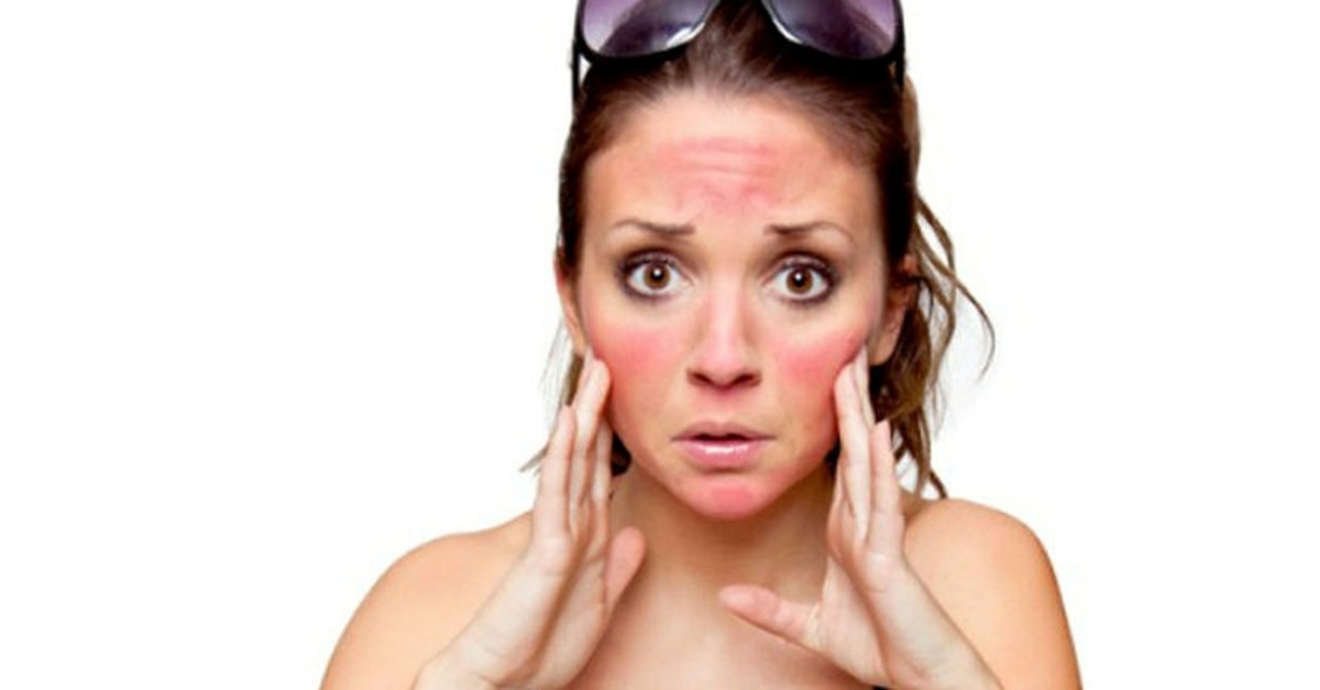 UV radiation from the sun can cause some allergies like skin redness.