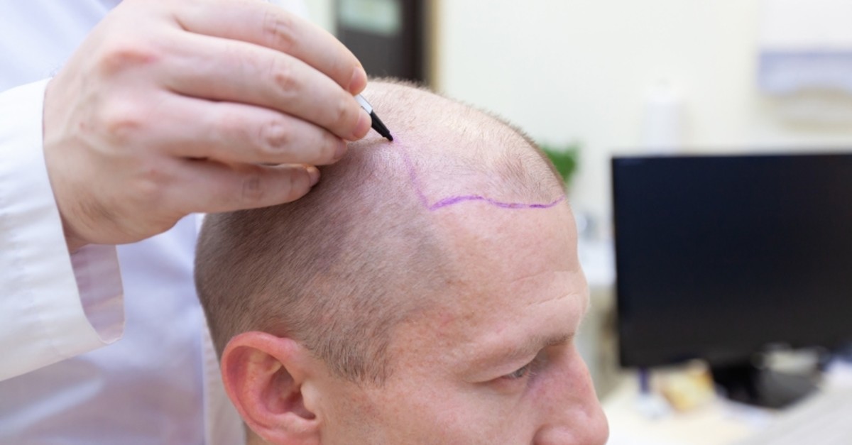 Hair Transplant - Hair Upload Clinic - Dr.Caymaz