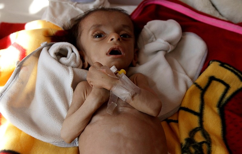 A malnourished boy lies on a bed at a malnutrition treatment center in Sanaa, Yemen November 21, 2017. (Reuters Photo)
