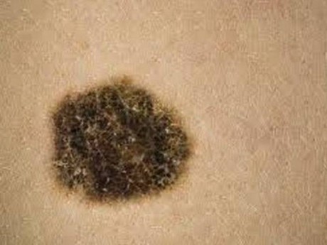 One in every three cancers diagnosed is a skin cancer, according to the WHO.