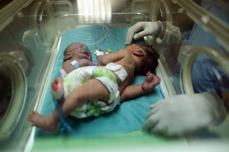 This file photo taken on October 22, 2017 shows then one-day-old Palestinian conjoined twins in an incubator at the nursery at al-Shifa Hospital in Gaza City. (AFP File Photo)