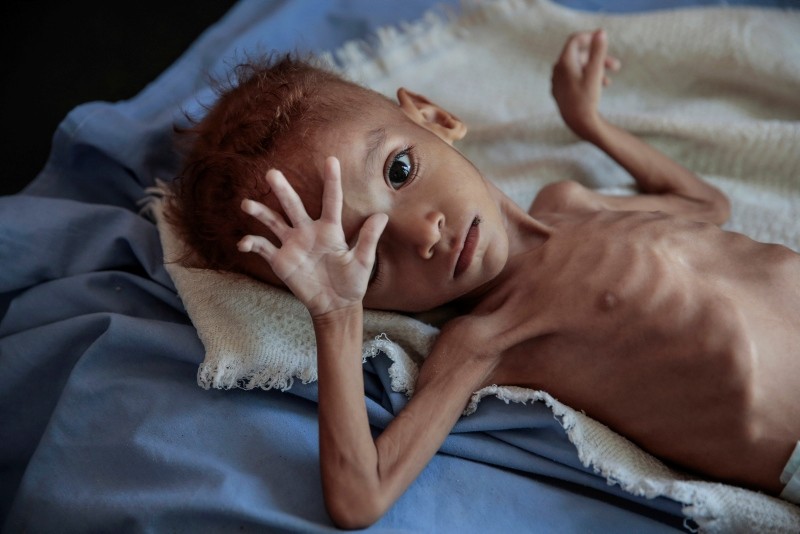 In this Oct. 1, 2018 file photo, a severely malnourished boy rests on a hospital bed at the Aslam Health Center, Hajjah, Yemen. (AP Photo)