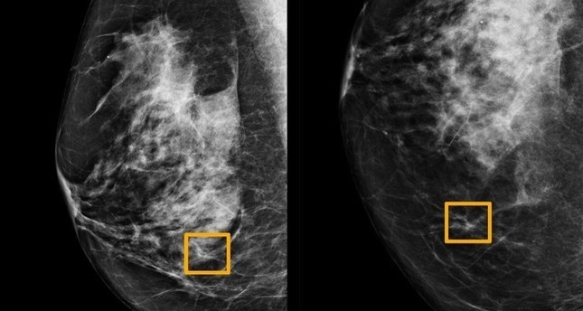 يشير المربع الأصفر إلى مكان العثور على نظام الذكاء الاصطناعي للسرطان مختبئًا داخل أنسجة الثدي، في صورة غير مؤرخة صدرت عن جامعة نورث وسترن في شيكاغو.