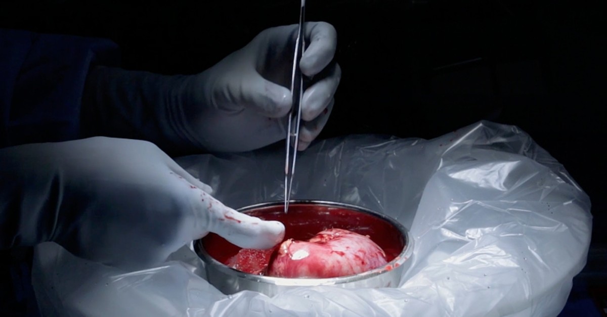 This image made from video provided by Johns Hopkins Medicine in Baltimore shows a kidney from Nina Martinez of Atlanta, who is thought to be the worldu2019s first kidney transplant living donor with HIV, on Monday, March 25, 2019. (AP Photo)