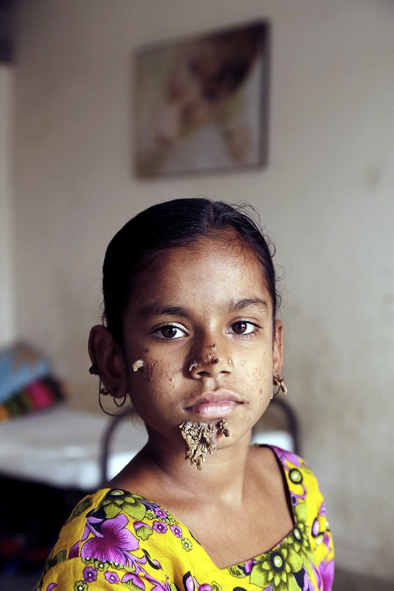 Shahana Khatun, a ten-year-old girl, sits during a medical check-up at the Dhaka Medical College Hospital in Dhaka, Bangladesh on Feb. 2, 2017. (EPA Photo)