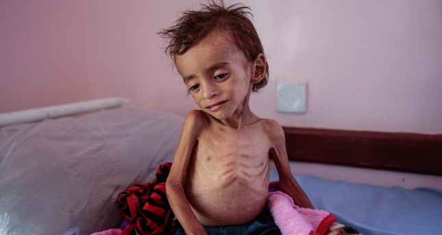 In this Oct. 1, 2018, photo, a malnourished boy sits on a hospital bed at the Aslam Health Center, Hajjah, Yemen. (AP Photo)